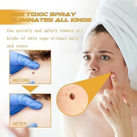 Wart & Skin Tag Removal Spray